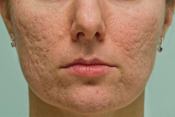 8 средств, чтобы избавиться от прыщей, шрамов и пигментных пятен на коже лица